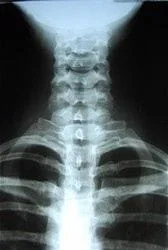 xray image of the cervical and upper thoracic spine