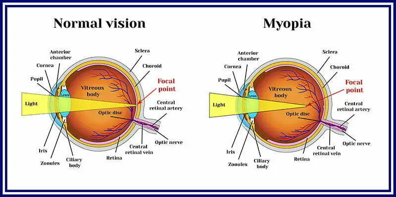 Myopia Chart