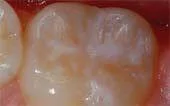 Sealant-After - Pediatric Dentist in Casper, WY
