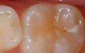 Sealant-Before - Pediatric Dentist in Jackson, New Jersey