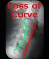 Loss_cervical_curve_edited_2.jpg