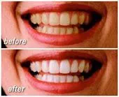 before and after image of woman's mouth, results of teeth whitening Mahwah, NJ
