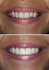 before and after image of woman's mouth cosmetic dentistry Mahwah, NJ