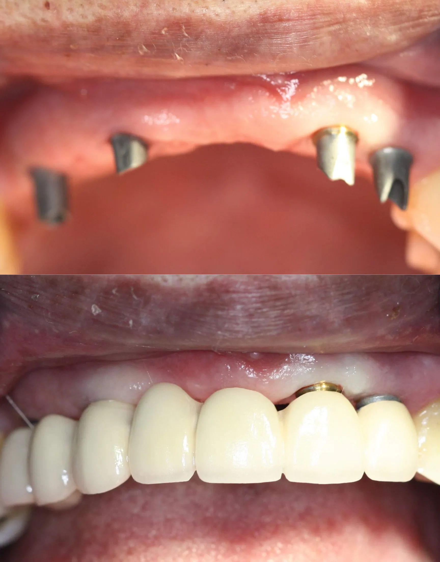 Multiple Implant Restoration