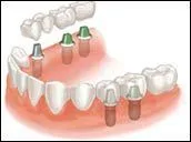 Dental Implants in Longwood, FL