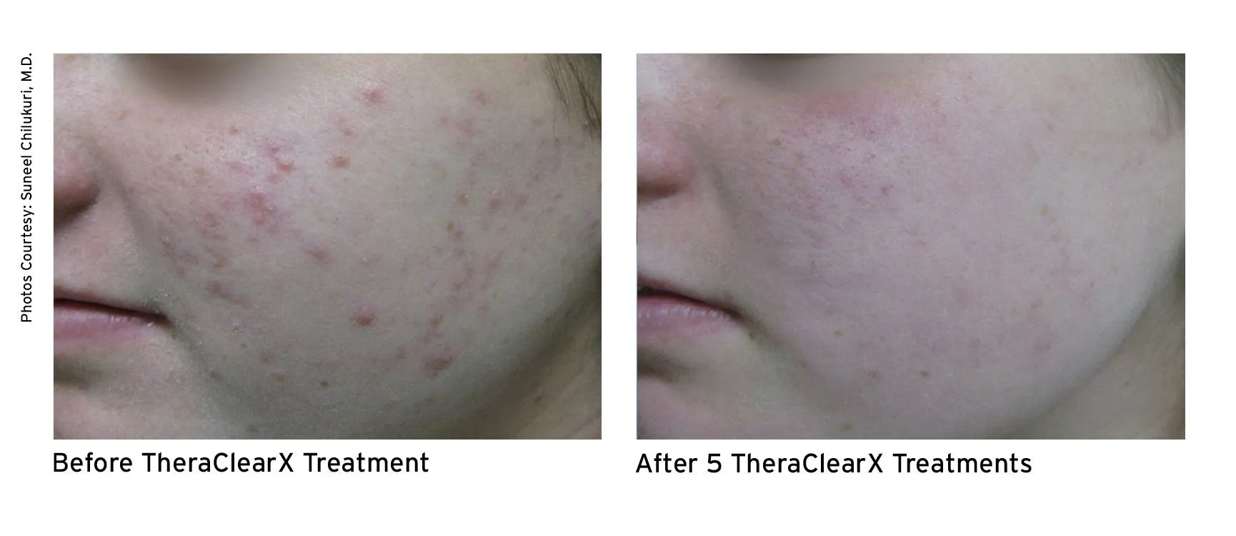 Before and after - Face 3 Temple