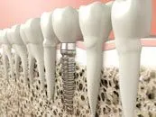 Dental Implant Photo - Dentist in Huntsville, AL