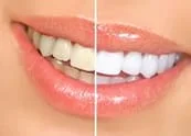 before and after results professional teeth whitening and cosmetic dentistry Plain City, OH