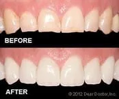 Cosmetic Dentistry before and after Wilmington, DE