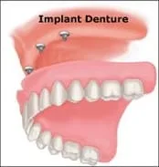 implant_denture_sm.jpg