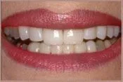 Whitening - After