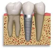 dental_implant.jpg