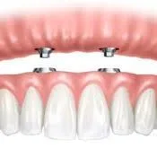 1 hour 30 minutes • Price varies An implant-supported prosthesis is a denture, which is both retained and supported by four or more dental implants. This means that the denture does not rest on the gums. Rather, it is fixed on implants, which are embedded in bone.