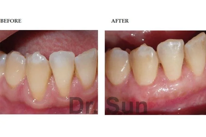 Before After Gum Graft, Cupertino CA