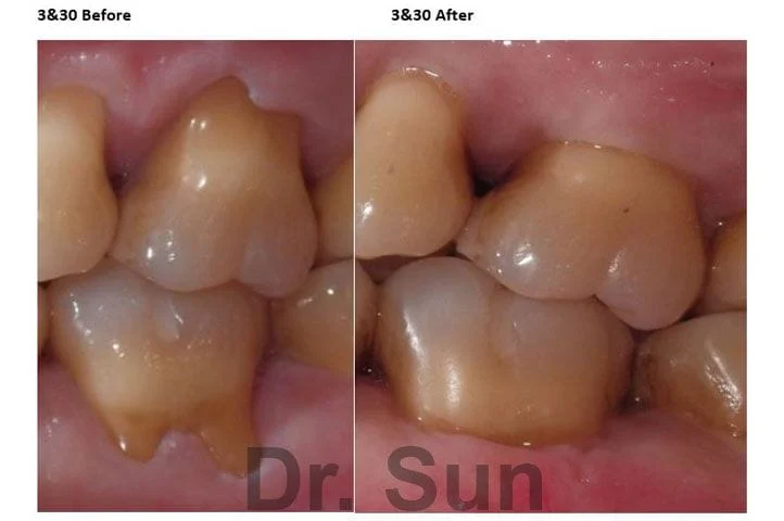 Gum Graft Cupertino CA Before After