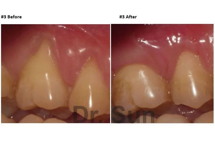 Before After Cupertino CA Gum Graft