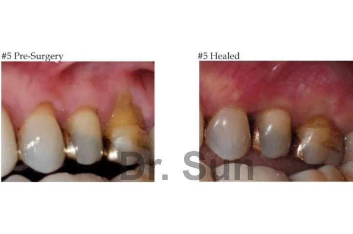 Cupertino Gum Graft Before After