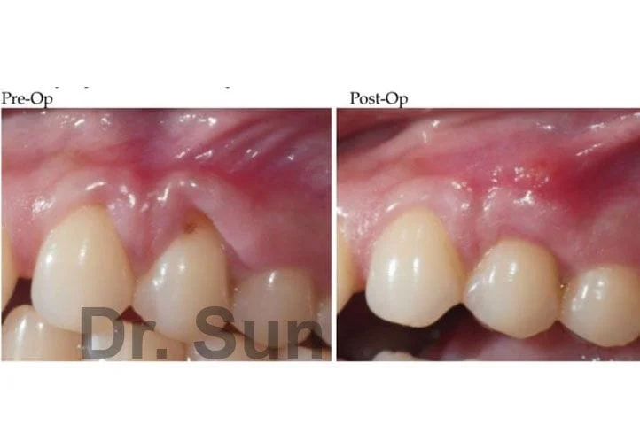 Gum Graft Before After Cupertino