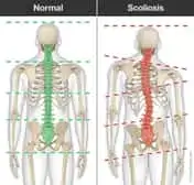 Scoliosis | Basalt, Aspen, Carbondale, Spine Spot Chiropractic