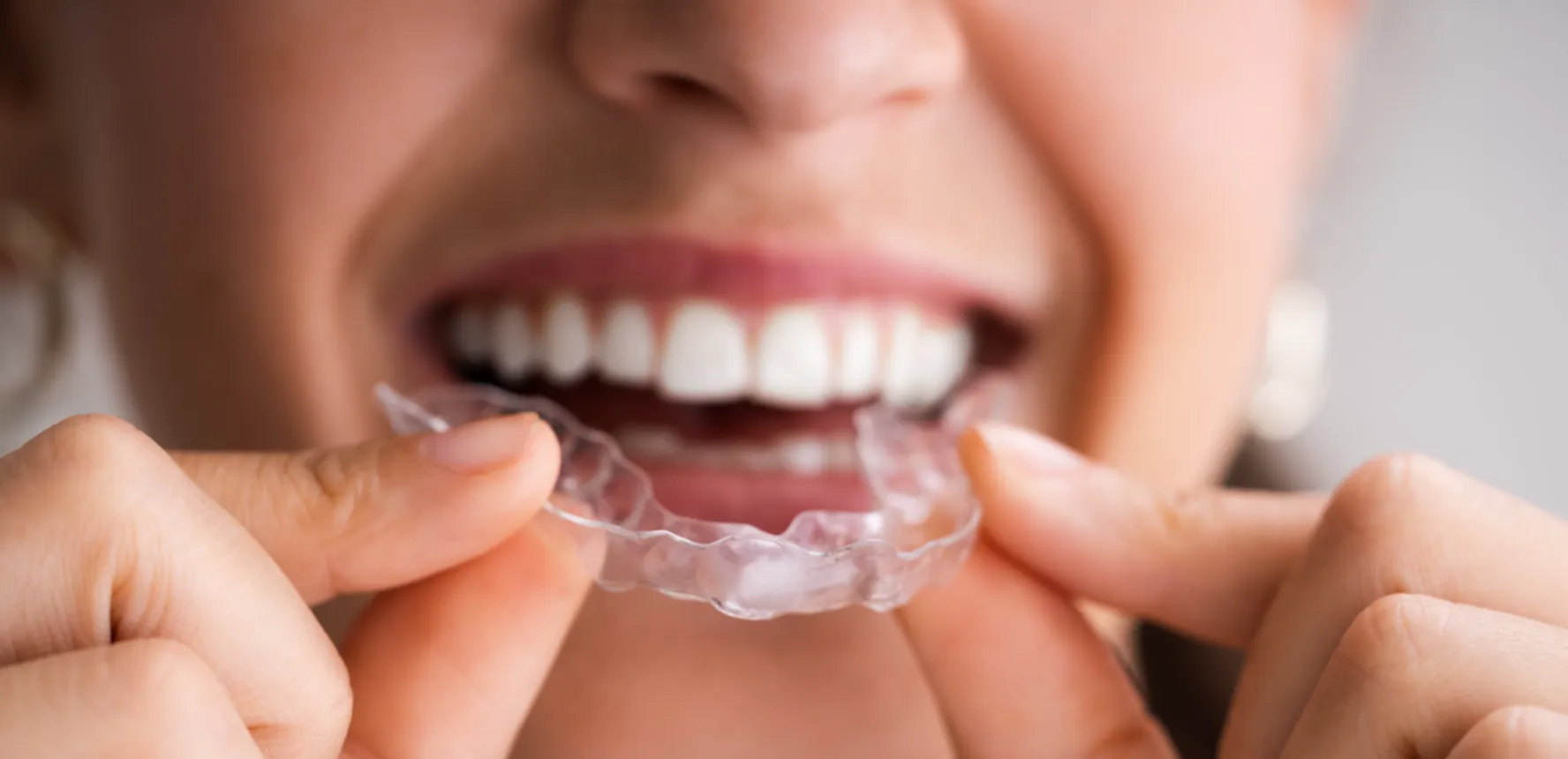 woman's hands holding clear aligner tray about to place on top teeth, Invisalign Millbrae dentist