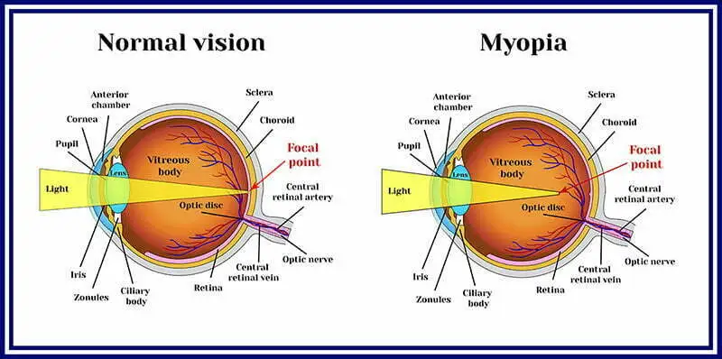 Myopia