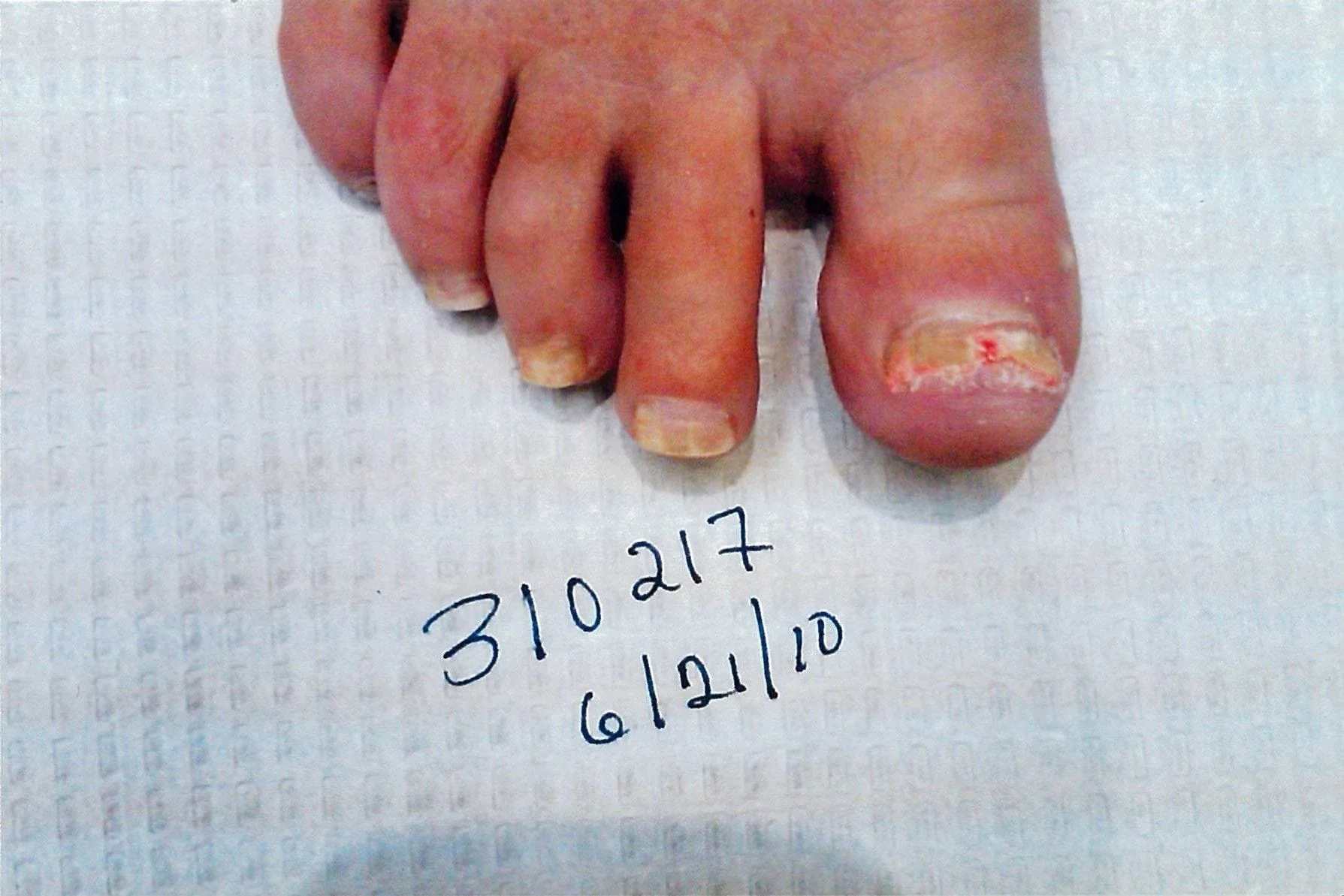 Patient 310217 Right Foot Before