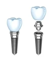 illustration showing parts of dental implant. post, abutment, and crown. dental implants Lawrenceville, GA dentist 