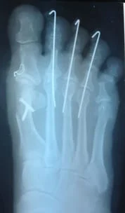 After Correctional Foot Surgery X-Ray 