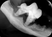 Abscessed tooth