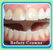 Porcelain Crowns