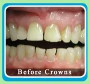 Porcelain Crowns