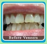 Porcelain Veneers