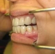 this is an after photo due to the deep discoloration we could not bleach and we had to place porcelain crowns and veneers