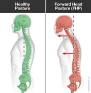 Forward Head Posture | Basalt, Aspen, Carbondale, Spine Spot Chiropractic