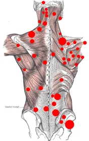 Trigger Points - Reid Clinic