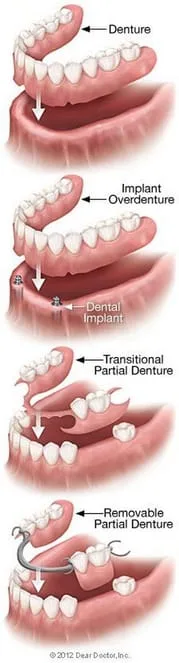 illustration of types of dentures Manteca, CA dentist