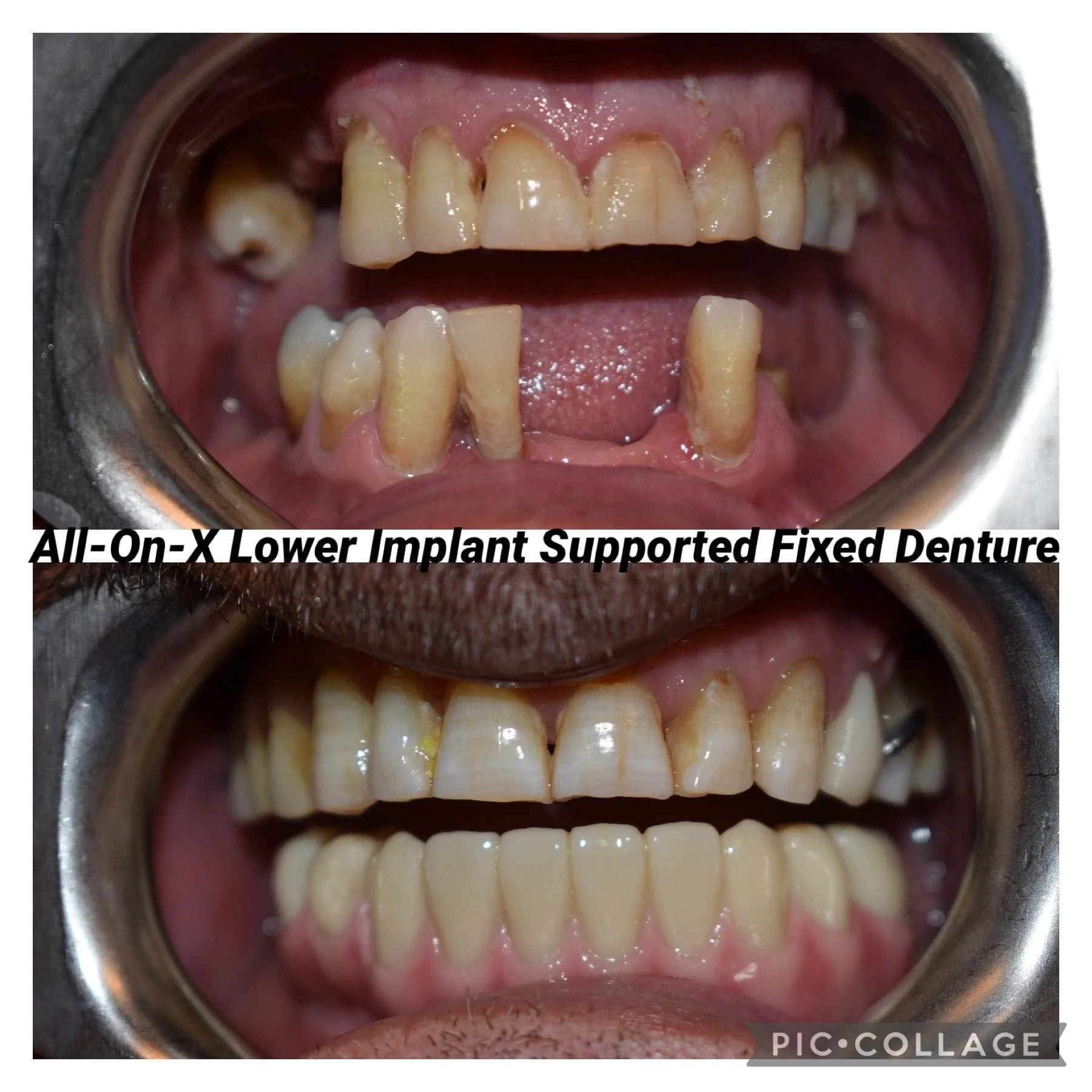 All-On-X Implant supported teeth