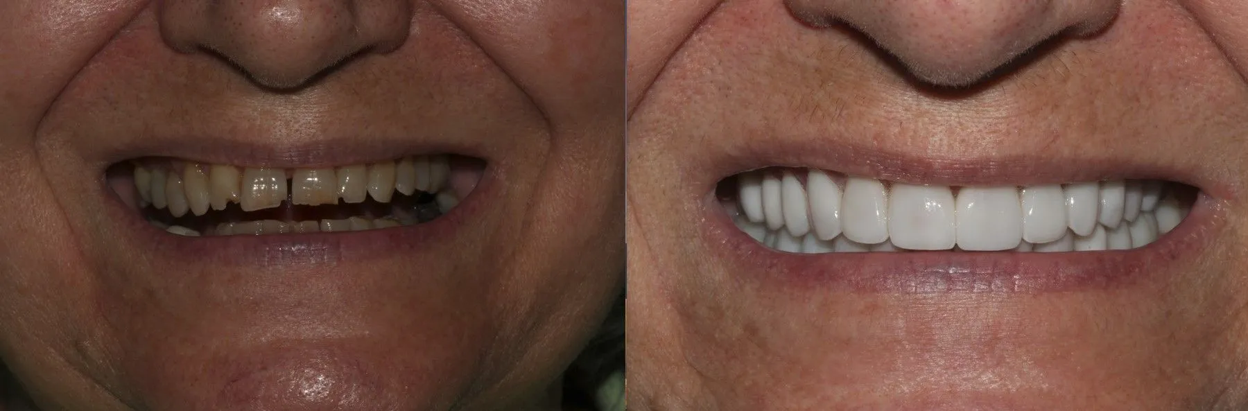 Smile Makeover