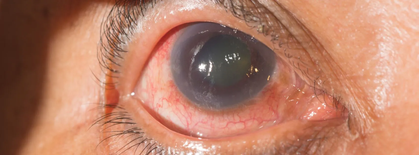 Glaucoma Eye Ball