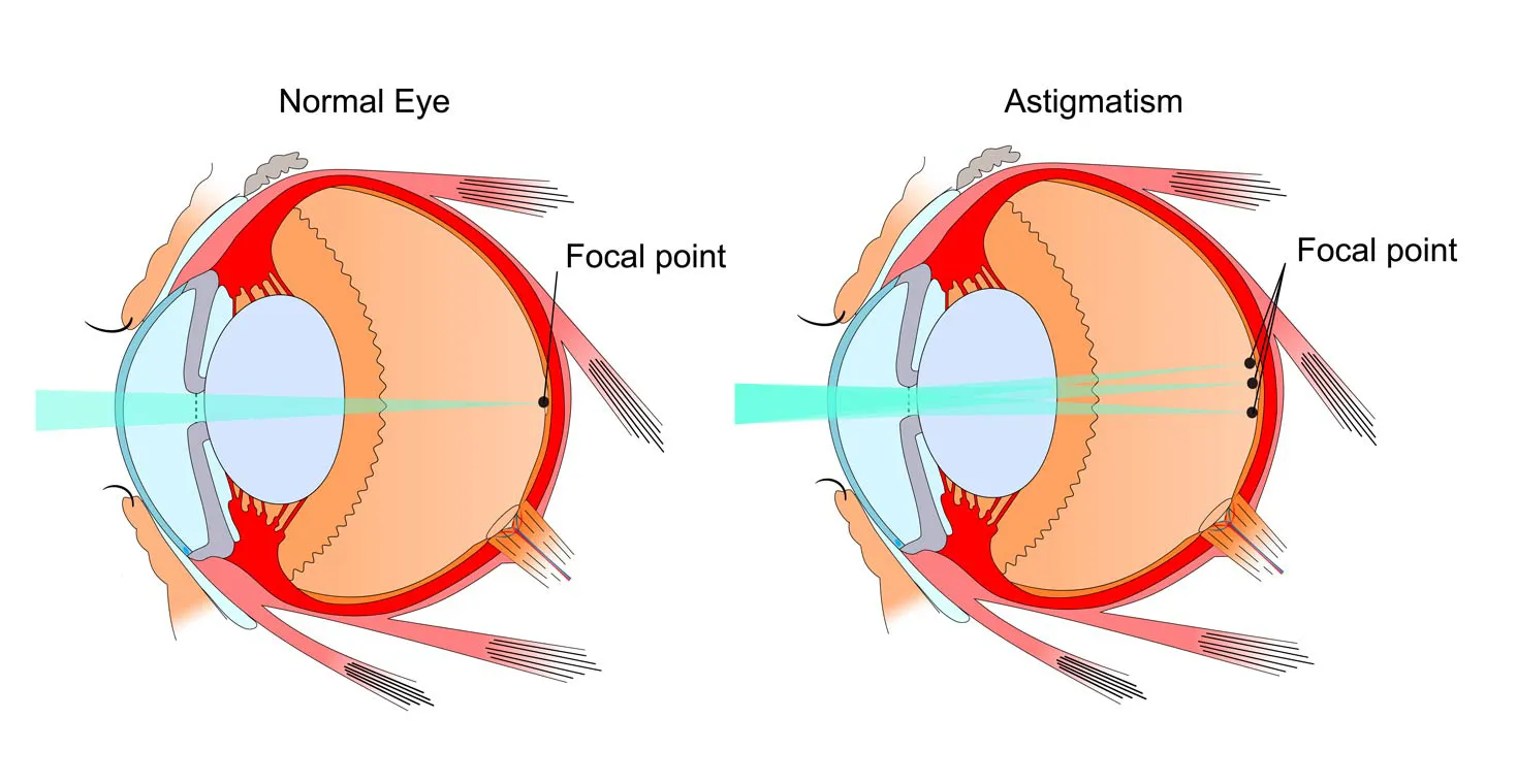 Astigmatism Treatment