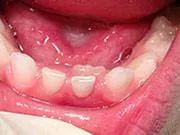Baby Teeth - Pediatric Dentist in Orlando, FL