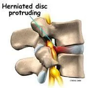 Herniated Disc needs Spinal Decompression
