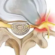 pinched nerve