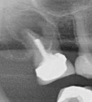Root_Canal