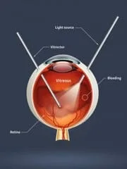 Diabetic retinopathy is a complication of diabetes mellitus