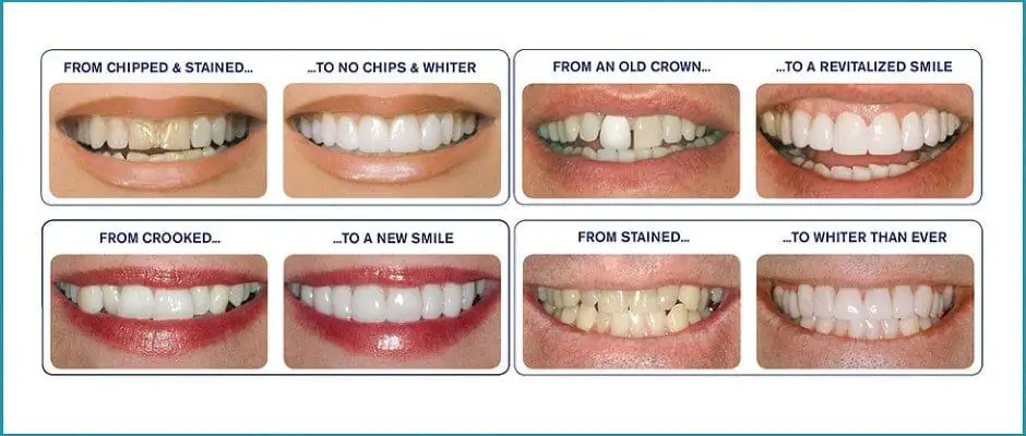 Veneers | Dentist in San Jose, CA | Dr. Pauline Lu, DDS