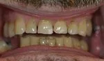 man's discolored, yellowed teeth before seeing cosmetic dentist Cumberland Park SA Adelaide