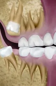 Backward distal impaction of wisdom tooth, Royal Palm Beach, FL wisdom tooth extraction