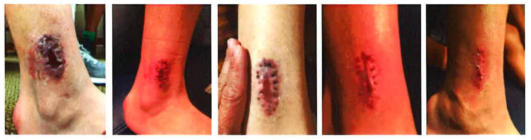 healing progress of surgical wound with Class IV laser therapy treatments