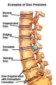 Fairfax Chiropractor | Fairfax chiropractic What is spinal decompression? |  VA |